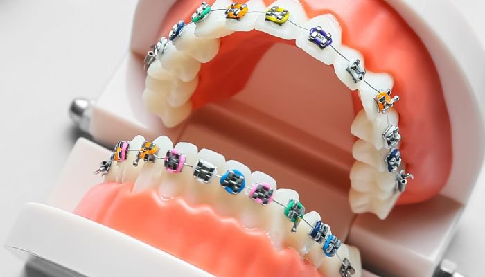 curiosidades de los brackets