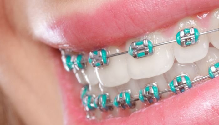 curiosidades de los brackets